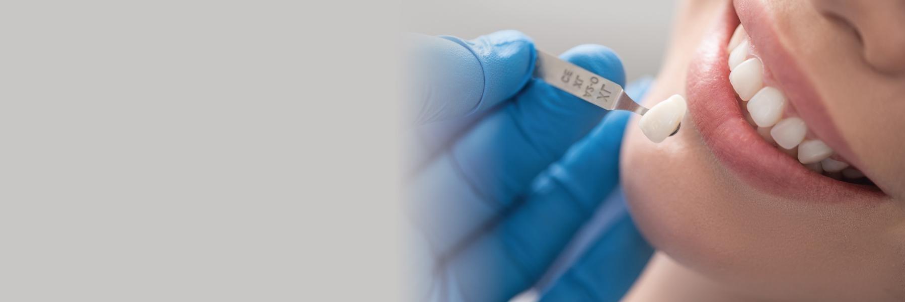 Composite Strip Crowns | Dentist